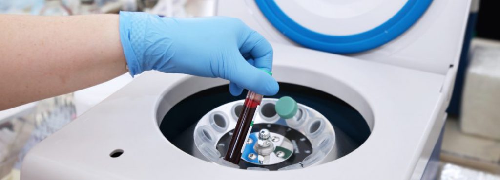 Tube of blood is placed in a medical centrifuge for plasma lifting